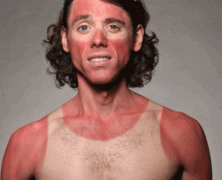 7 Reasons Being Sunburnt Has Its Advantages